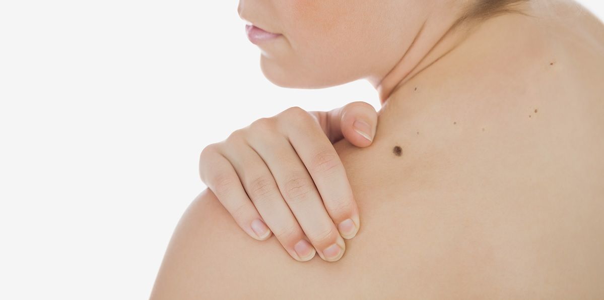 Melanoma: principales factores de riesgo