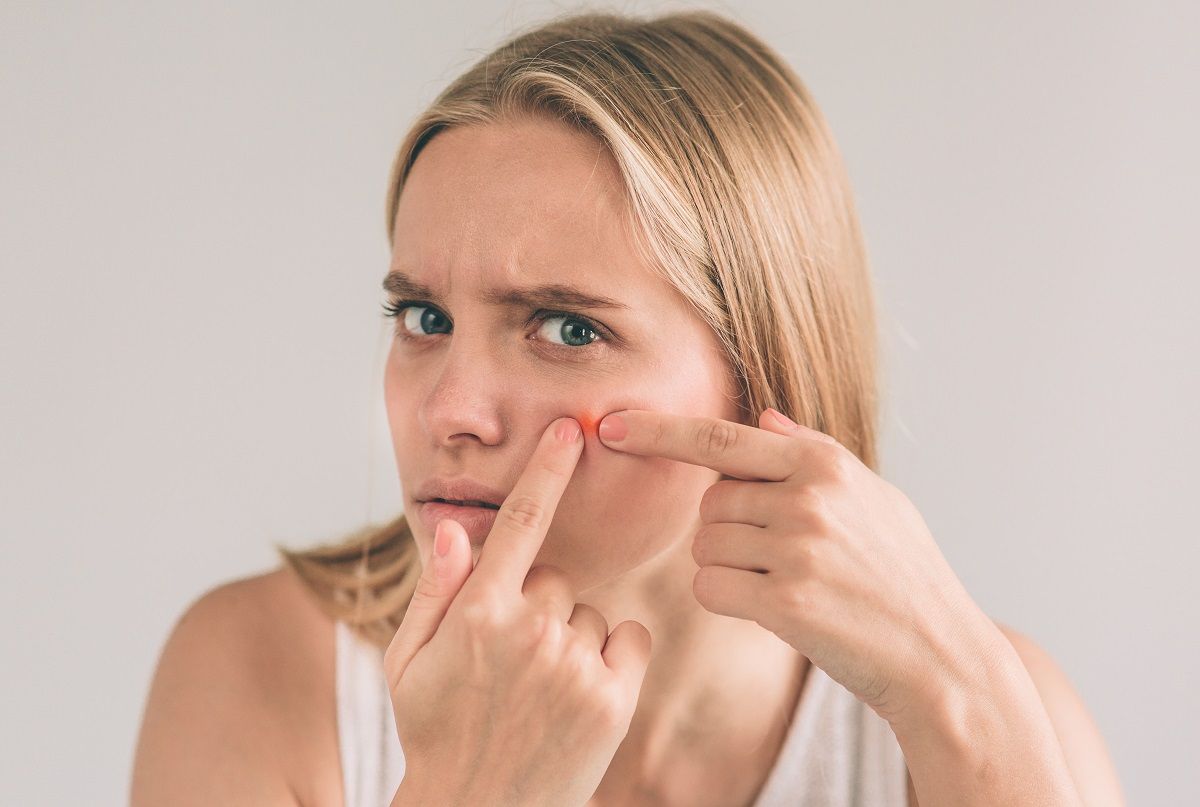 11 estrategias para combatir el acné