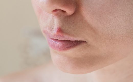 Herpes labial: ¿qué es y por qué aparece?